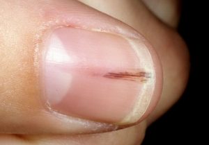 علت افتادن خط سیاه روی ناخن